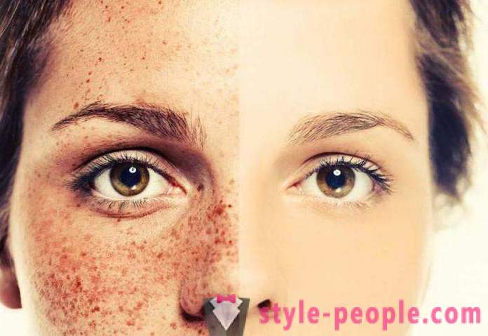 Bagaimana untuk menghilangkan freckles? ubat krim dan kaum yang Sangat freckles