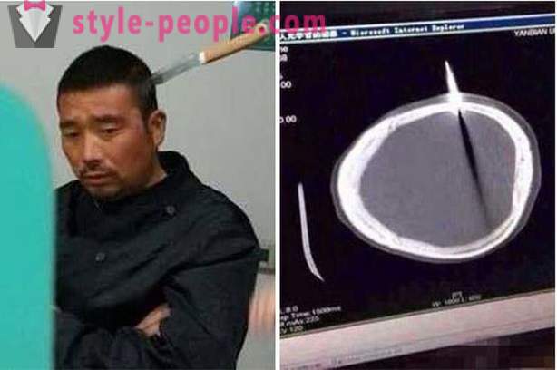 Seorang lelaki Cina dengan pisau di kepalanya dia pergi ke doktor