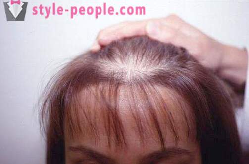 Rambut Darsonval. darsonvalya permohonan untuk rawatan dan pencegahan keguguran rambut