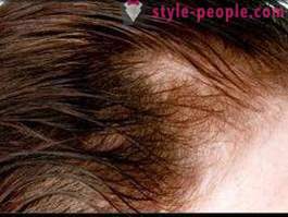 Mengapa rambut gugur selepas kelahiran? Apa yang perlu dilakukan untuk menjaga rambut anda tebal?